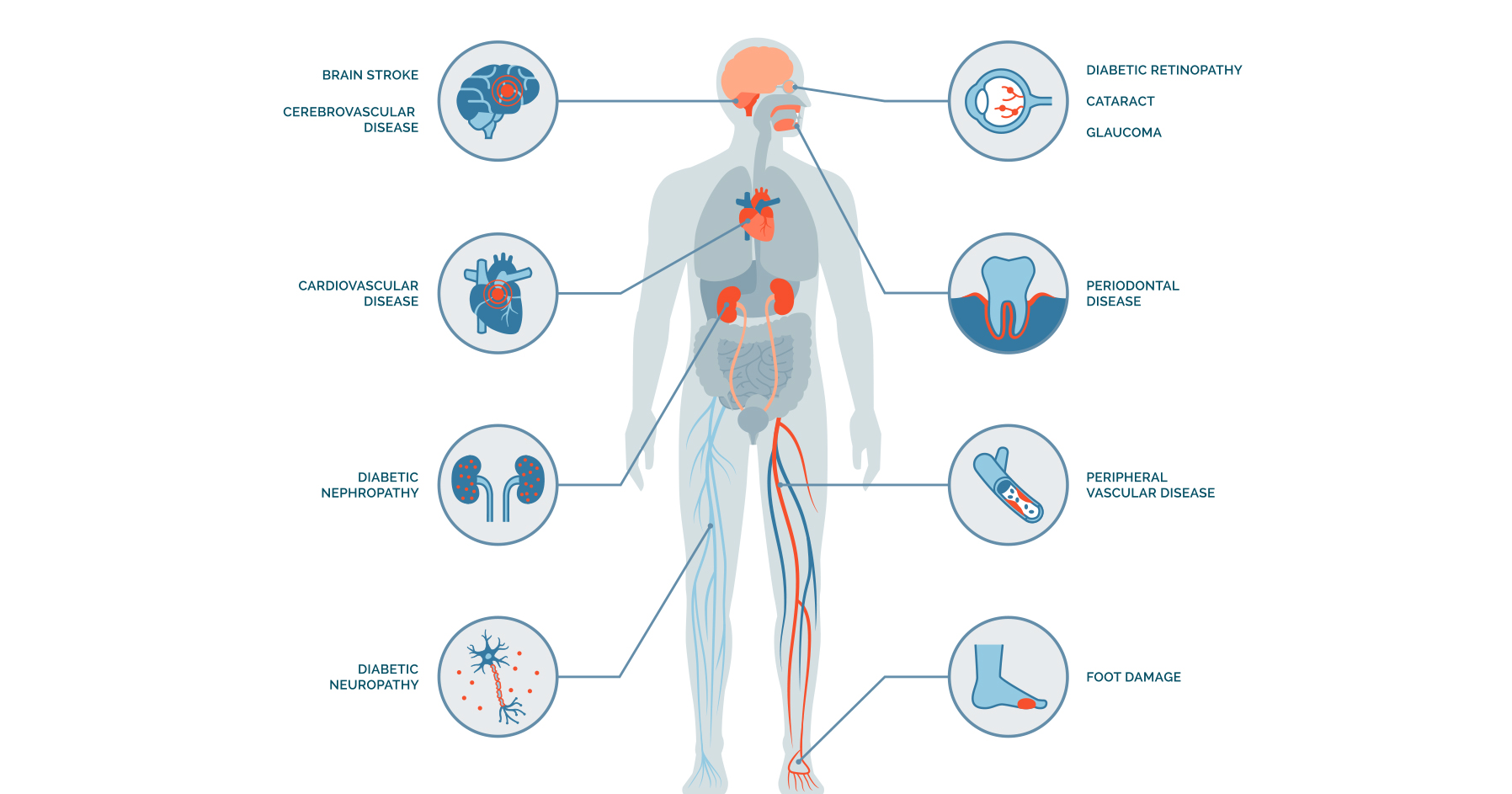 Diabetes Complications Endocrine Society